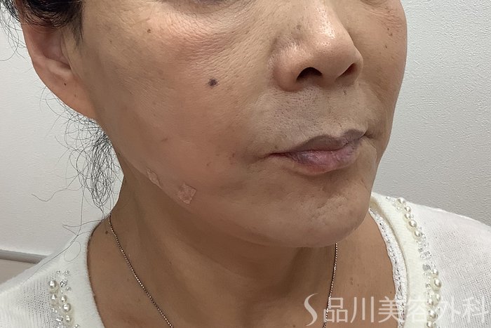 症例NO.62155のAFTER写真