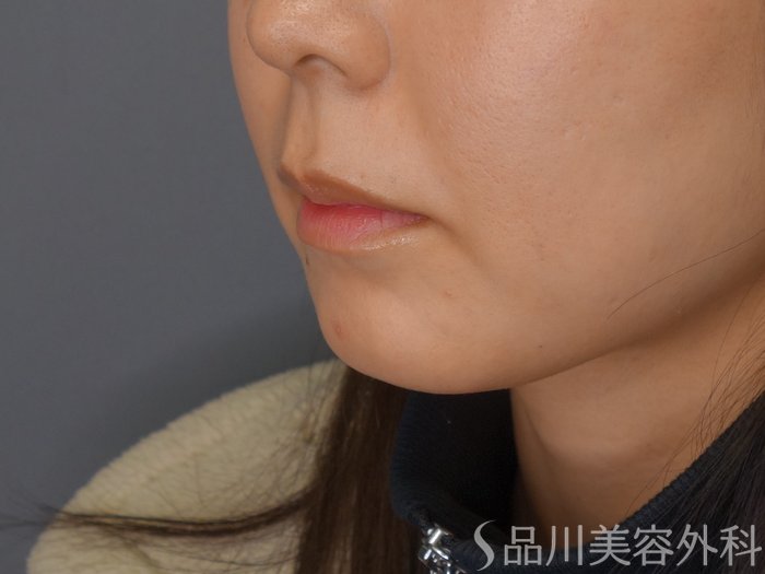 症例NO.68418のBEFORE写真