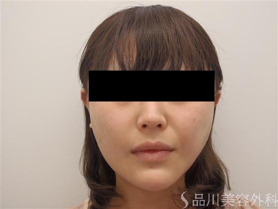 症例NO.6171のAFTER写真