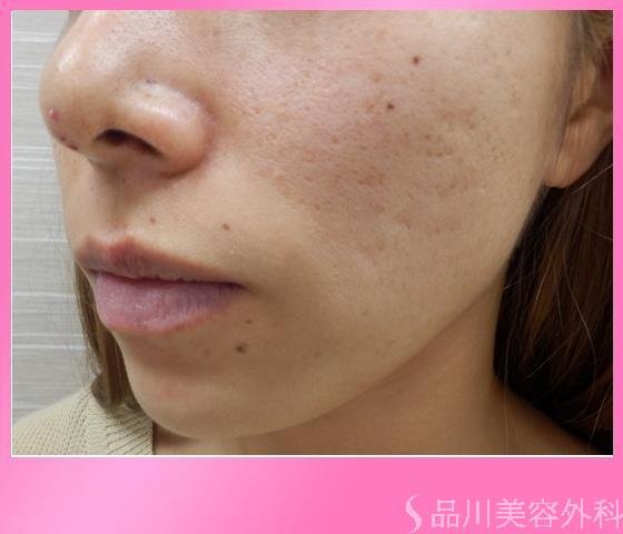 症例NO.11643のAFTER写真