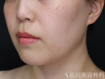 症例NO.72167のBEFORE写真