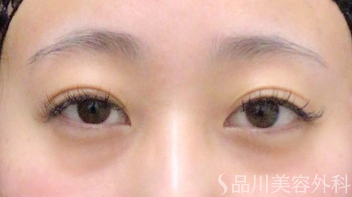 症例NO.69635のAFTER写真