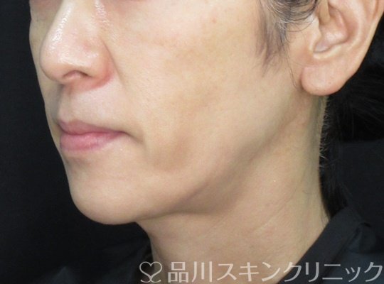 症例NO.71866のBEFORE写真