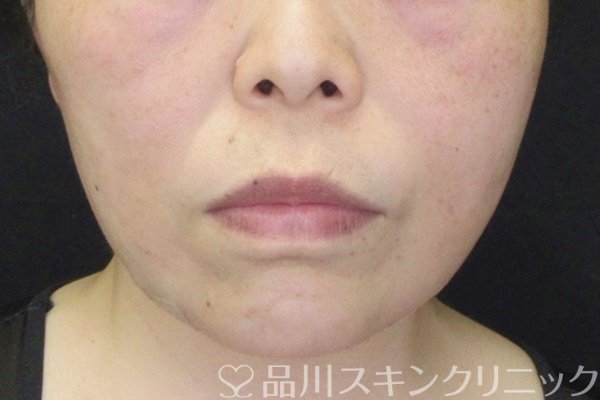 症例NO.64776のAFTER写真