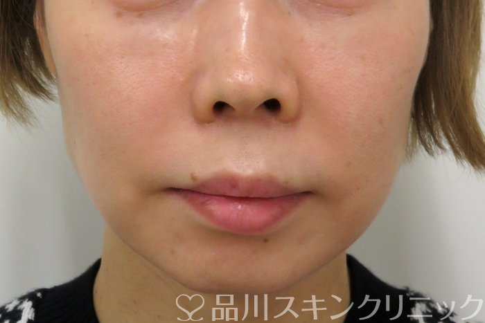 症例NO.74781のBEFORE写真