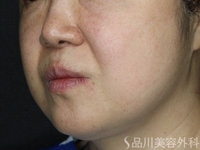 症例NO.70345のBEFORE写真