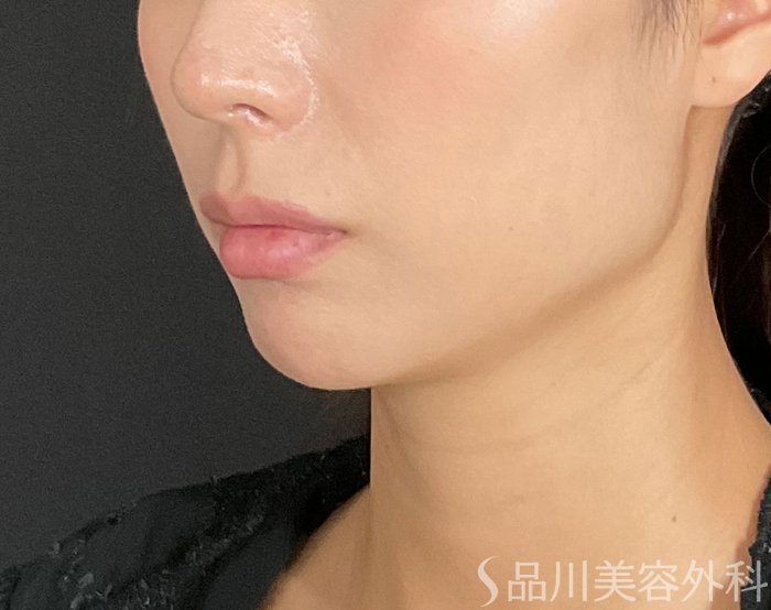 症例NO.74507のBEFORE写真