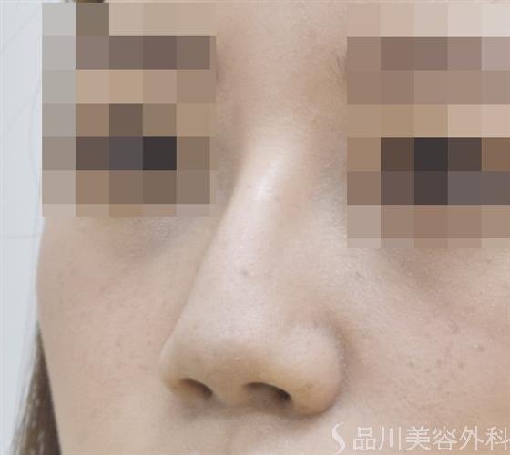 症例NO.45651のAFTER写真