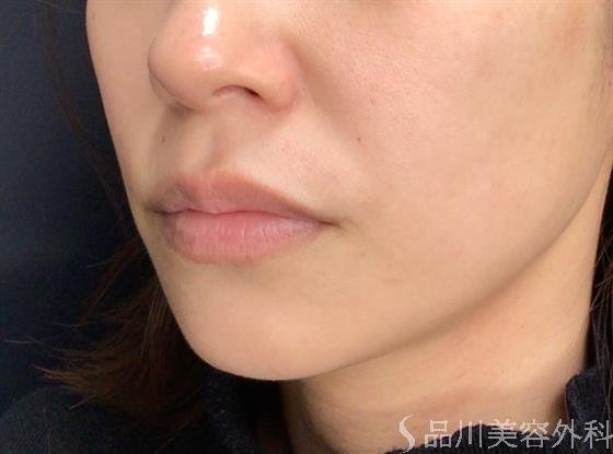 症例NO.59152のAFTER写真