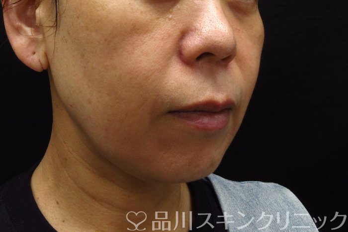 症例NO.74355のBEFORE写真