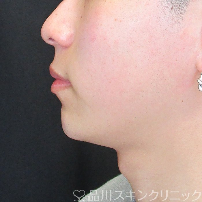 症例NO.73728のAFTER写真