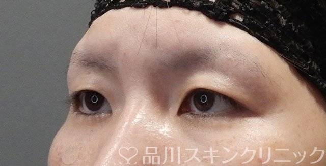 症例NO.75077のBEFORE写真