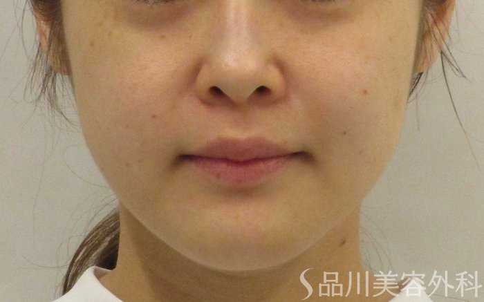 症例NO.70606のBEFORE写真