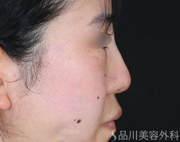 症例NO.73555のAFTER写真