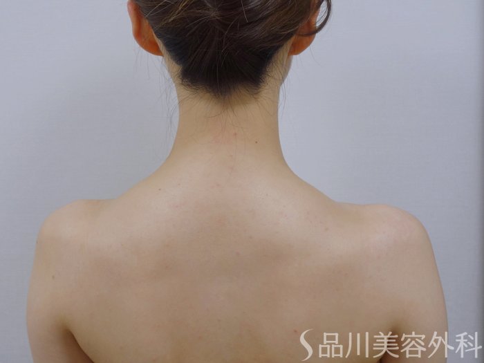 症例NO.74501のAFTER写真