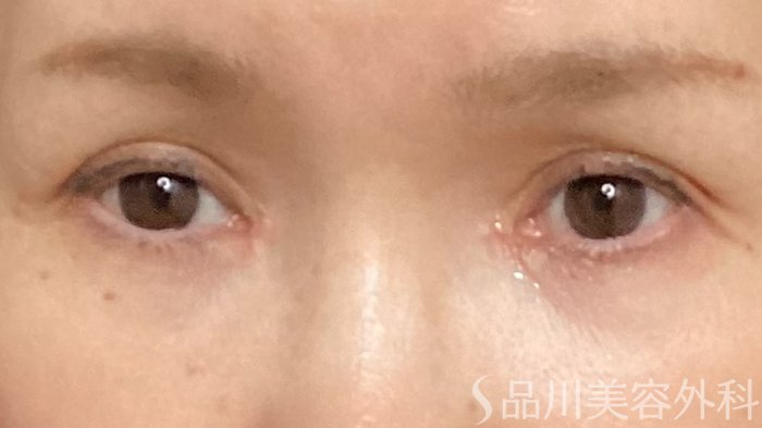 症例NO.64750のAFTER写真