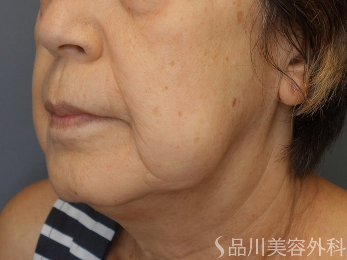 症例NO.69451のBEFORE写真