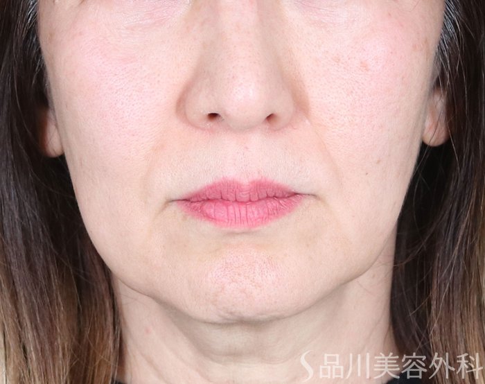 症例NO.73911のBEFORE写真