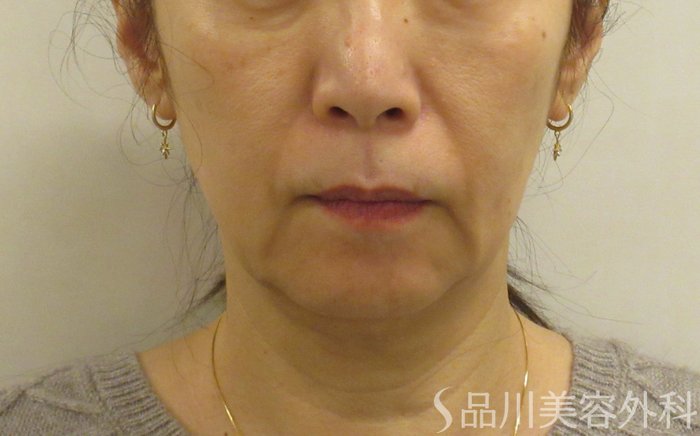 症例NO.72764のBEFORE写真