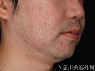 症例NO.71703のBEFORE写真