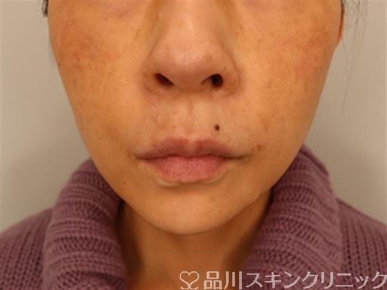 症例NO.50413のAFTER写真