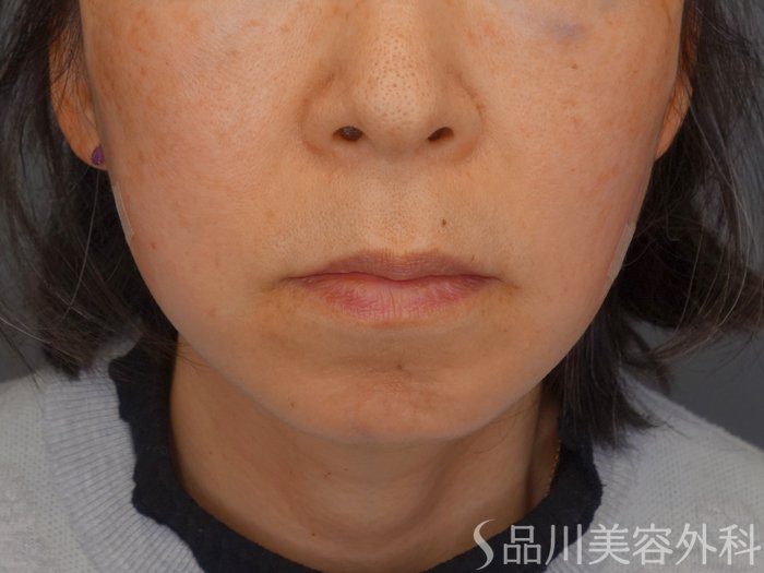 症例NO.72689のAFTER写真