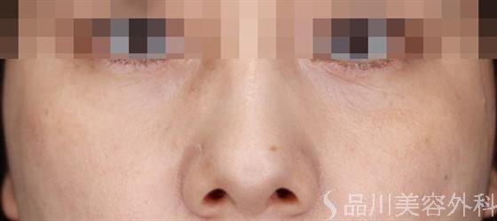 症例NO.61680のAFTER写真