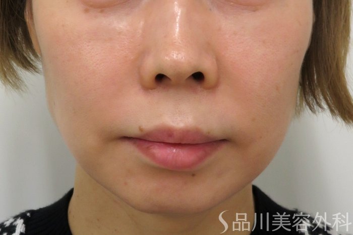 症例NO.74781のBEFORE写真
