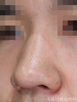 症例NO.70034のBEFORE写真