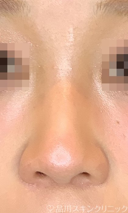 症例NO.72796のAFTER写真