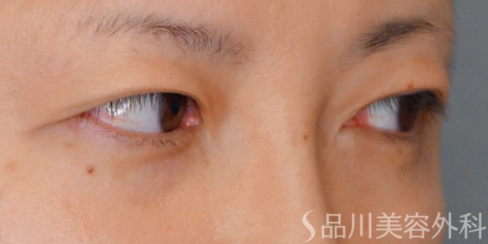 症例NO.69650のBEFORE写真