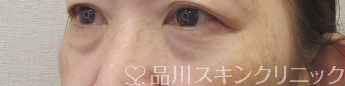 症例NO.71297のBEFORE写真