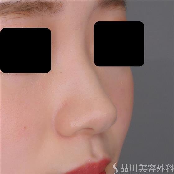 症例NO.54217のBEFORE写真
