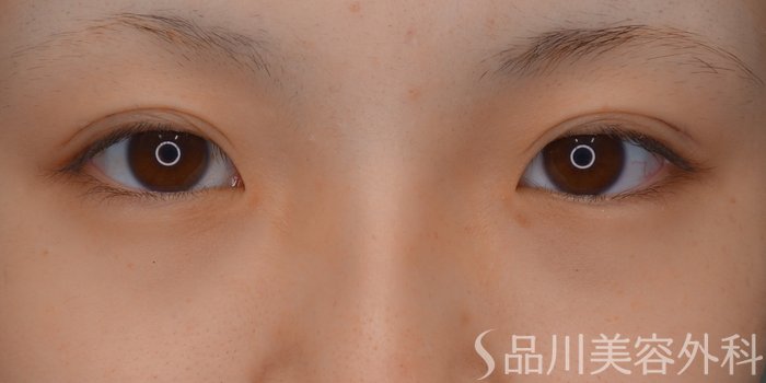 症例NO.75129のBEFORE写真