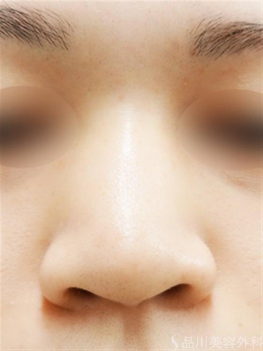 症例NO.16569のBEFORE写真