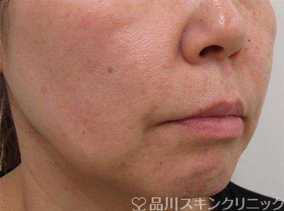 症例NO.41629のBEFORE写真