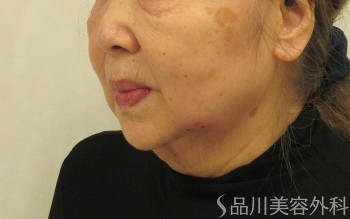 症例NO.72065のAFTER写真