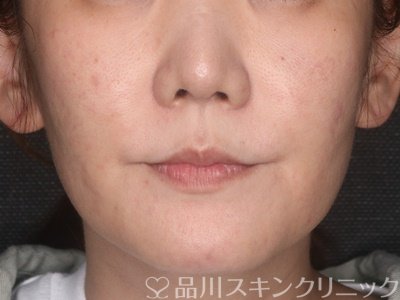 症例NO.72217のBEFORE写真