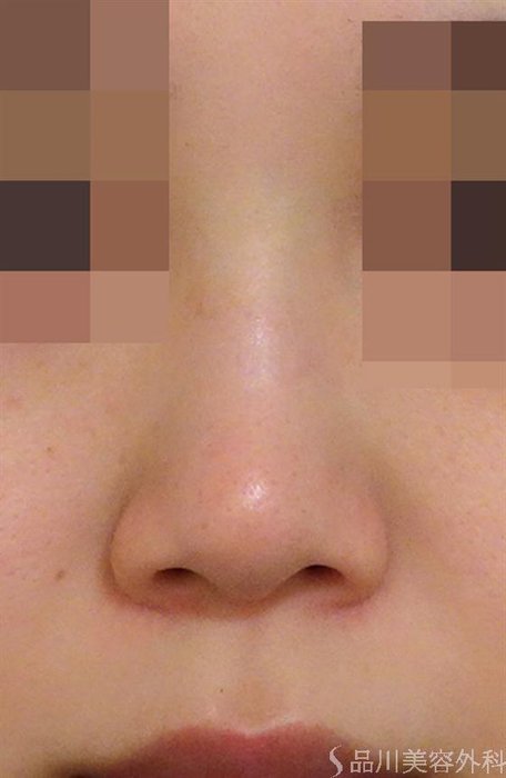 症例NO.44042のBEFORE写真