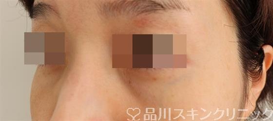 症例NO.50525のAFTER写真