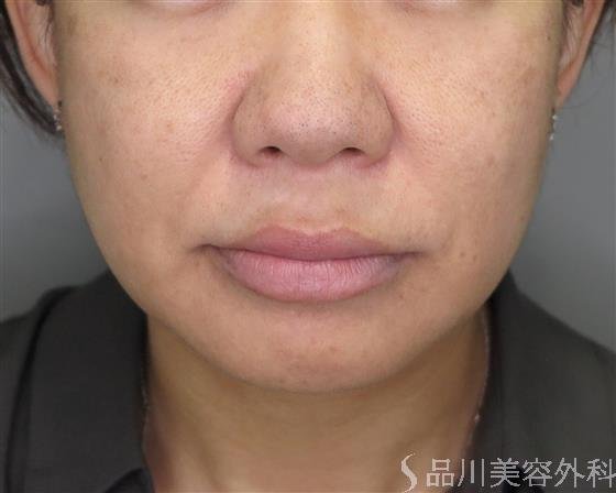 症例NO.47827のBEFORE写真