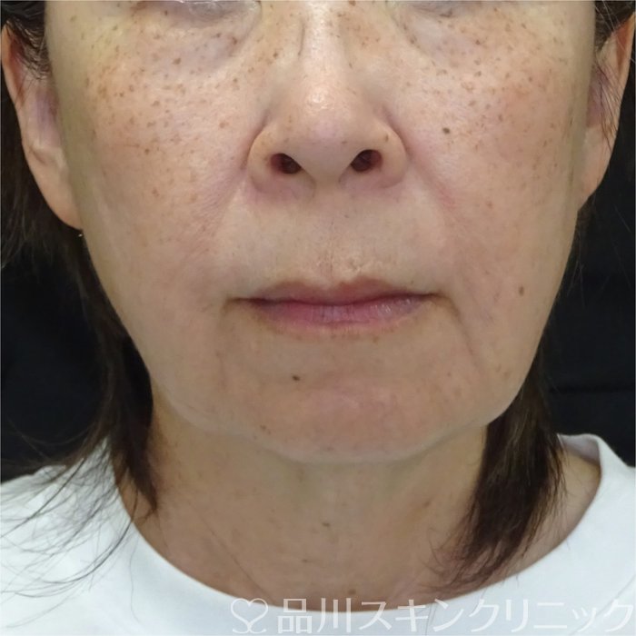 症例NO.71172のBEFORE写真