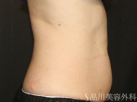 症例NO.71341のBEFORE写真