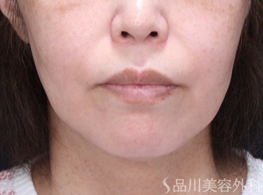 症例NO.70231のBEFORE写真