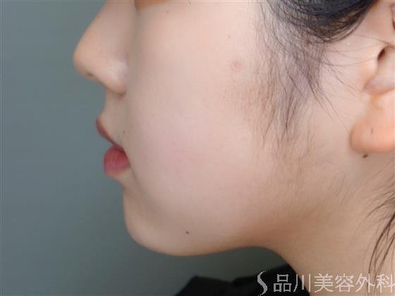症例NO.51001のAFTER写真