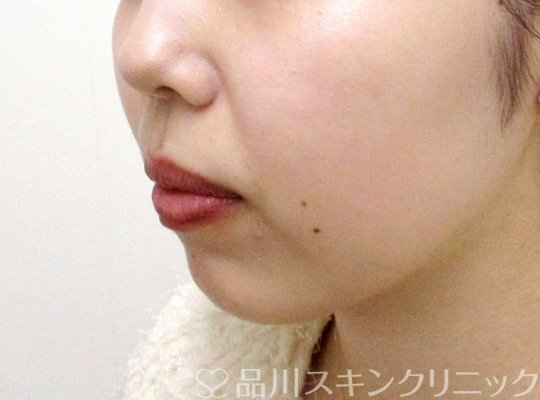 症例NO.65155のBEFORE写真