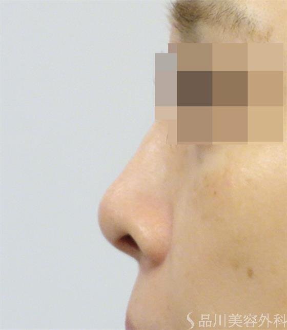 症例NO.44136のBEFORE写真
