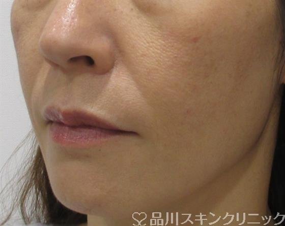 症例NO.32796のBEFORE写真