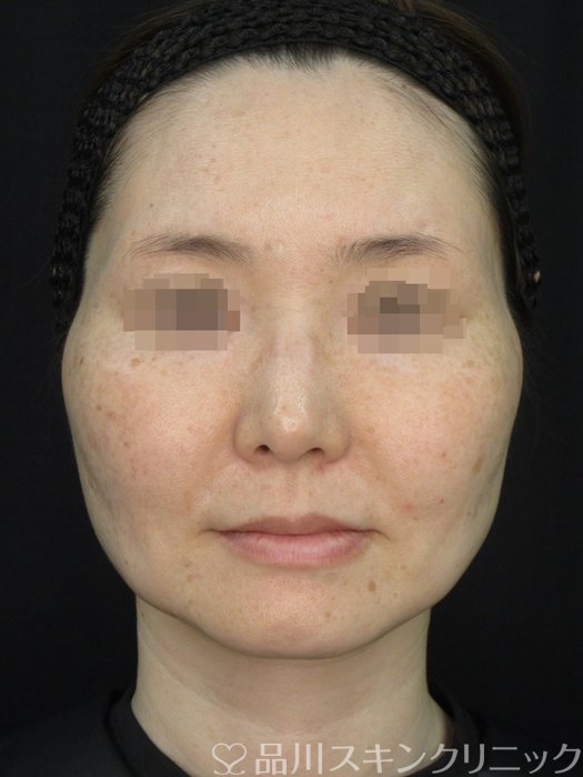 症例NO.71649のAFTER写真