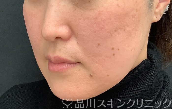 症例NO.69484のBEFORE写真